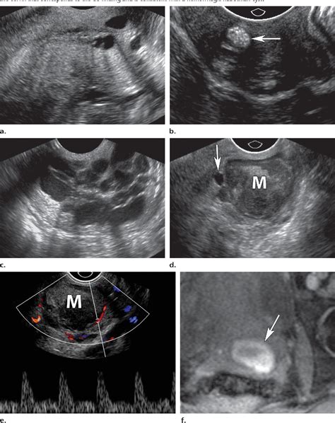 Figure 11 From Us Of The Nongravid Cervix With Multimodality Imaging Correlation Normal