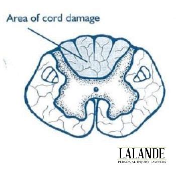 What is Posterior Cord Syndrome? | Hamilton Spinal Cord Injury Lawyers