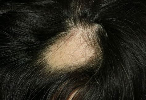 Qué Es La Alopecia Areata Causas Y Tratamientos
