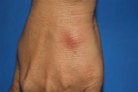 Erythema Nodosum At The Dorsum Of The Left Hand In A Patient Diagnosed Download Scientific