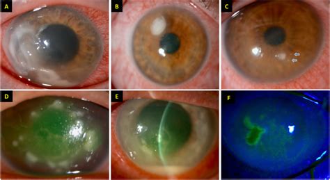 Diagnostic Armamentarium Of Infectious Keratitis A Comprehensive