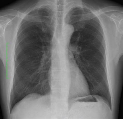 The Chest X‐ray Was Normal With A Normal Cardiothoracic Ratio Of 42 Download Scientific Diagram