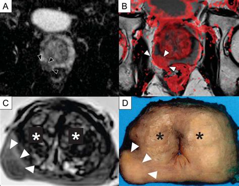 Scielo Brazil Multiparametric Magnetic Resonance Imaging Of The