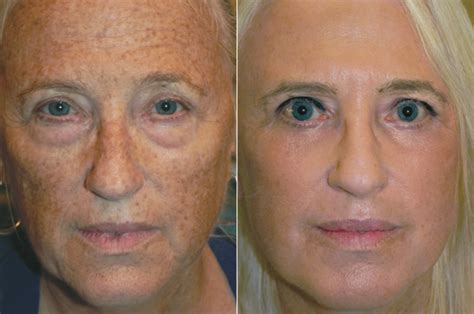 Old RESET Skin Resurfacing Dr Adam Scheiner