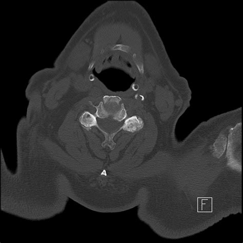 Fileodontoid Fracture Anderson And Dalonzo Type 3 Roy Camille Type 1 Radiopaedia 88042