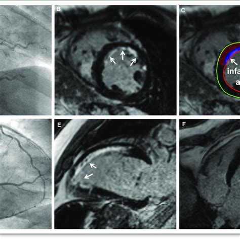 Transmurality Index And Myocardial Salvage Index Time Dependent