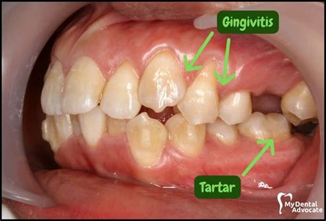 👀 What Does Gingivitis Look Like 20 Gum Disease Pictures