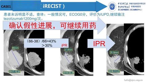 实体瘤疗效评价标准解读肿瘤