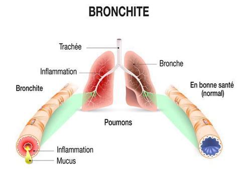 Toux Quand Faut Il Consulter Doctissimo