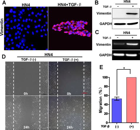 High vimentin expression correlated with TGF β induced EMT in oral