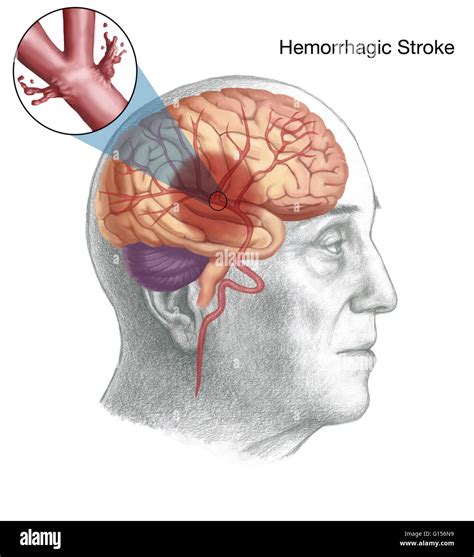 Illustration Of The Mechanism Of A Hemorrhagic Stroke Specifically An