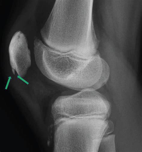 X Ray Lateral View Of The Right Knee Green Arrows Shows The