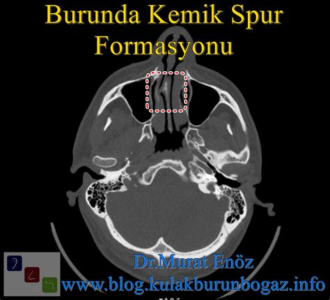 Health Zone Turkey: Nasal Bone Spur - Symptoms, Diagnosis, Treatment