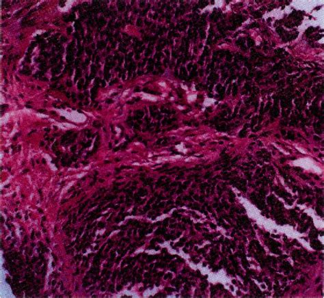 Figure 2 From Intra Abdominal Desmoplastic Small Round Cell Tumor