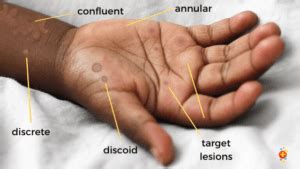 Paediatric Dermatology