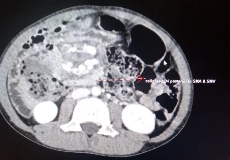 Midgut Volvulus CT - Sumer's Radiology Blog