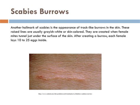 PPT - What Is Scabies? PowerPoint Presentation - ID:2457230