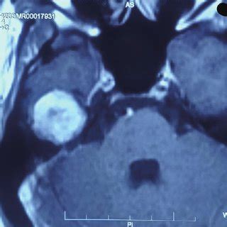 Contrast Enhanced MRI Sagittal Axial And Coronal Sections Showing