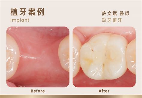 植牙案例分享｜缺牙植牙－祐民牙醫 許文斌醫師bpr Case 祐民牙醫
