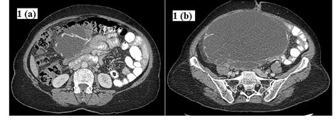 Figure From Borderline Ovarian Mucinous Tumor With Anaplastic