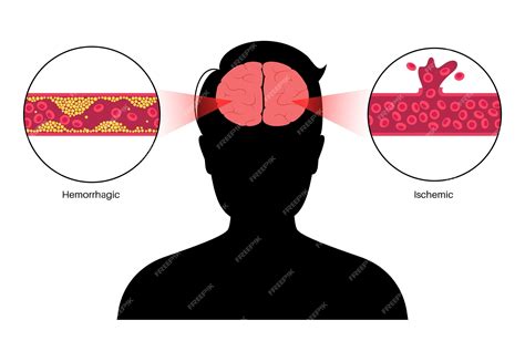 Premium Vector Brain Stroke Ishemic And Hemorrhagic