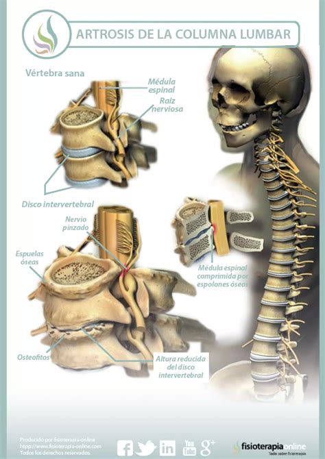 Artrosis Lumbar Qu Es Causas S Ntomas Tratamiento Y Consejos