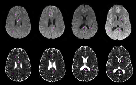 Figure From Susac Syndrome Brain Mri Findings In Patients At Our