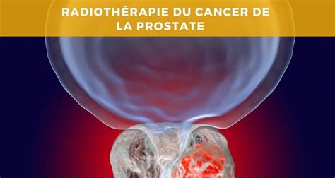 Contabile Estendere Cifra Cancer De La Prostate Stade Vita Complesso