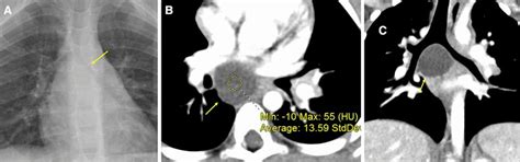 Bronchogenic Cyst Subcarinal Frontal Radiograph Of The Chest A In