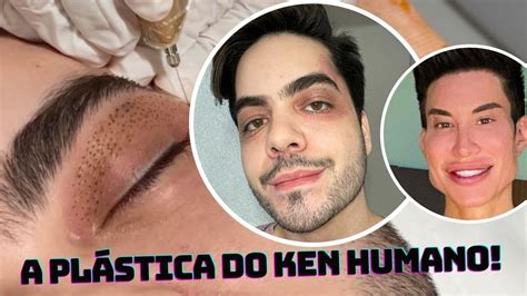 FIZ BLEFAROPLASTIA JATO DE PLASMA E OLHA NO QUE DEU O KEN HUMANO