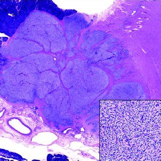 Low Grade Mesenchymal Neoplasm Involving Pancreatic Parenchyma And