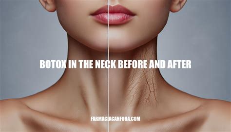 Botox In The Neck Before And After