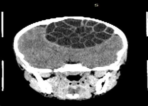 A Sagittal Contrast Enhanced Computed Tomography Of The Brain