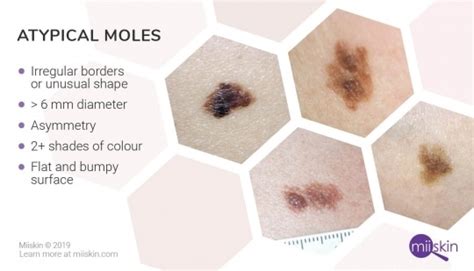 About Moles Types Warning Signs Causes And Prevention