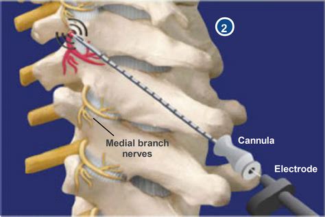 Cervical Facet Radiofrequency Neurotomy