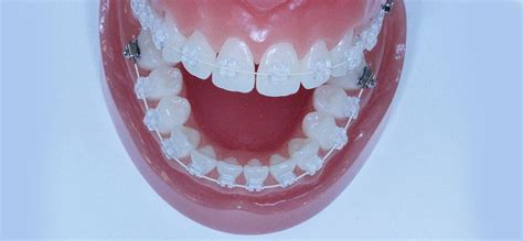 Brackets cerámicos de porcelana ventajas estéticas Ferrus Bratos