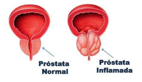 Pr Stata Inflamada S Ntomas Causas Y Tratamiento Demedicina