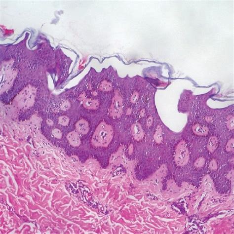 Ways to classify epidermal nevus syndrome | Download Scientific Diagram