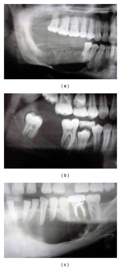 Radiographic Presentations Of Unicystic Ameloblastoma A Multilocular