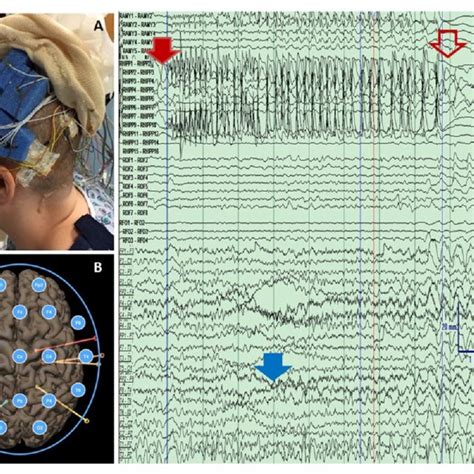 Simultaneous Intracranial And Scalp Eeg Ssieeg A Scalp Eeg Download Scientific Diagram