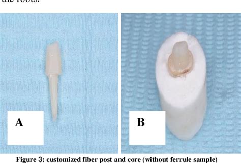 Figure 3 from Ferrule Effect on Fracture Resistance of Endodontically Treated Teeth Restored ...