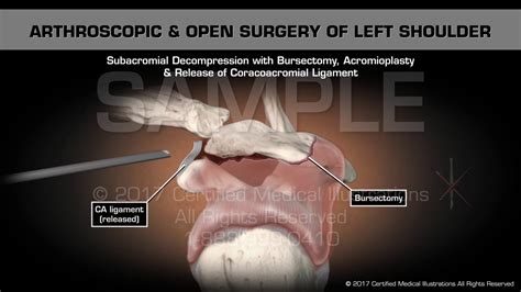 Arthroscopic Open Surgery Of Left Shoulder Youtube