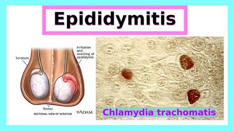 Epididymitis Youtube