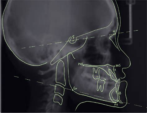 Cephalometric Landmarks Anatomic Landmark N Nasion S Sella ANS