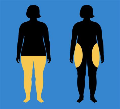 TOPIC: Non-surgical treatment, newly diagnosed, stage 1 : r/lipedema