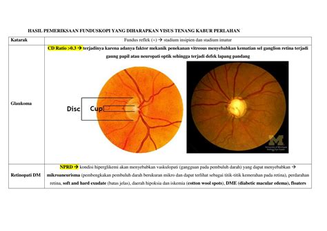 SOLUTION Catatan Mata Part 2 Hasil Pemeriksaan Funduskopi Mata Dan