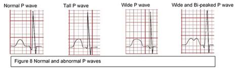 Normal Pediatric Ecg