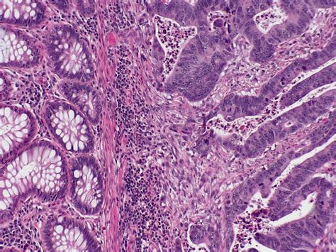 Post-Op Chemo No Help in Adequately Pretreated Rectal Cancer