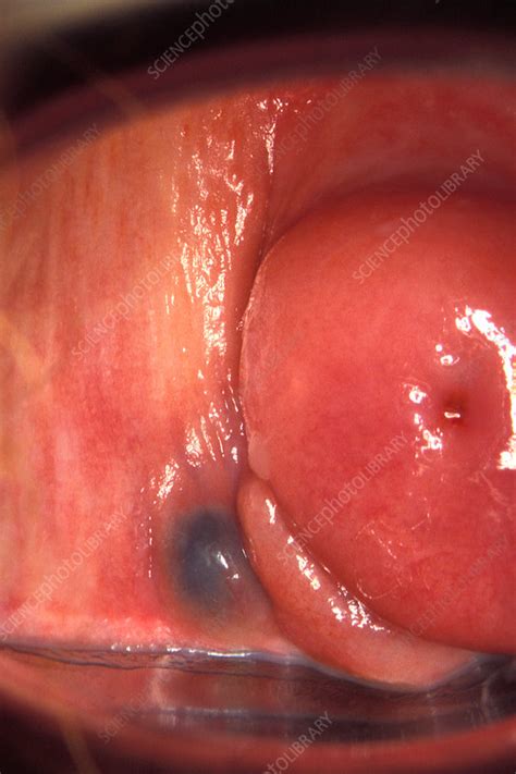 Endometriosis In The Vagina Colposcopy Stock Image C034 5644