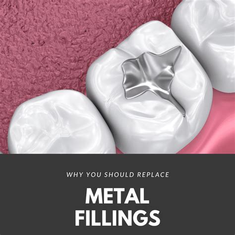 Why You Should Replace Metal Fillings | Cromwell Dentists | Fedorciw ...